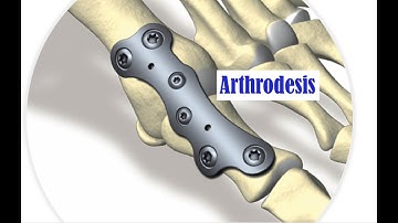 Arthrodesis CPT codes - simplify medical coding