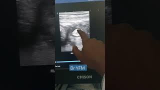 22 yrs F with abdominal pain of 3 days...appendiceal abscess (RLQ collection+ extraluminal gas)