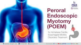 POEM Surgery (Peroral Endoscopic Myotomy)  | POEM Procedure for Achalasia Cardia Treatment