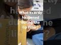Lip Filler in Action – Real-Time Injection for Natural Volume