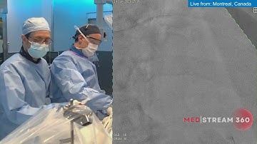 Orbital Atherectomy for LAD Calcification In A Patient With Stable Angina