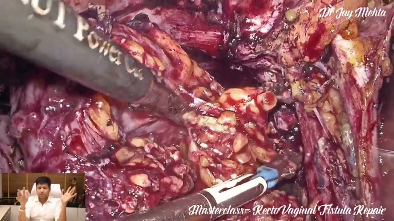 Masterclass- Laparoscopic Recto-Vaginal Fistula Repair | Fistula Surgery | Dr Jay Mehta