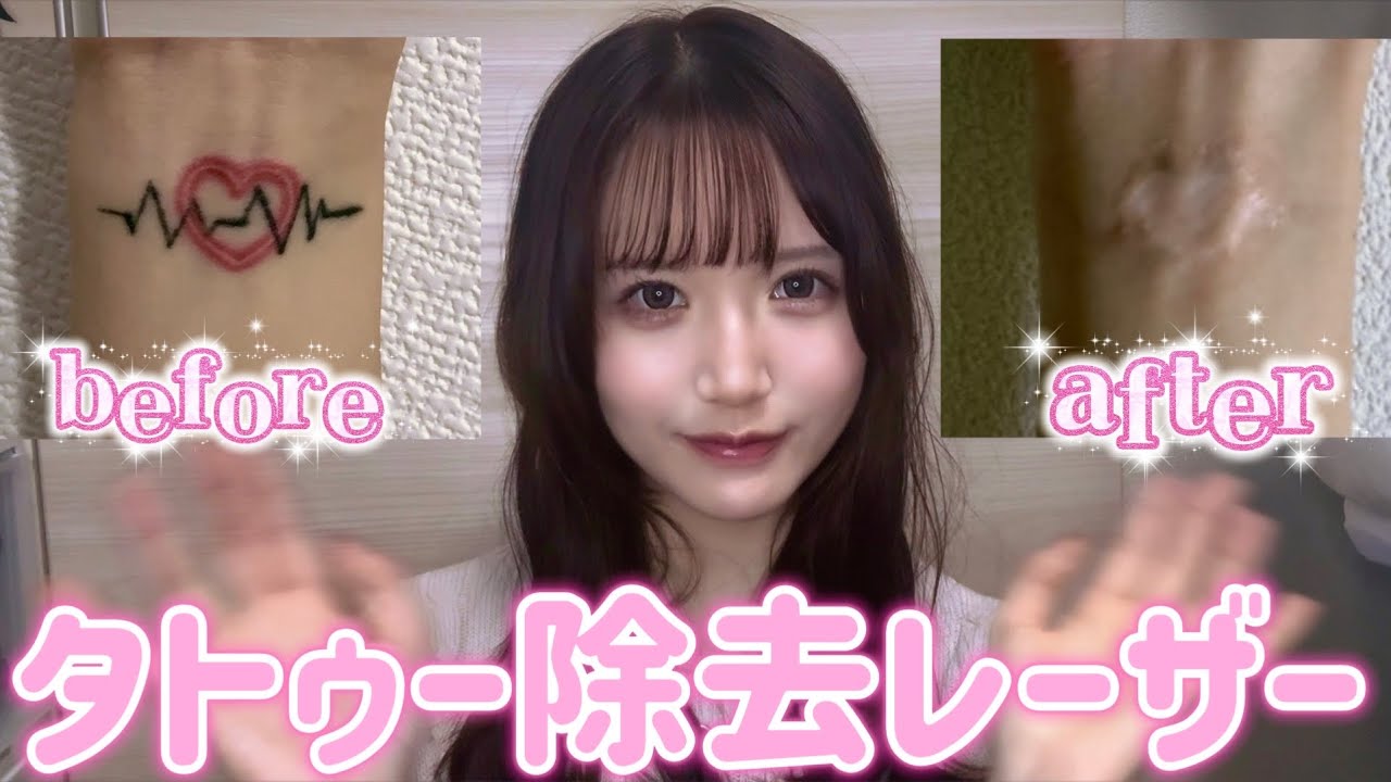 【2年間】タトゥー除去レーザー9回した経過😭😭