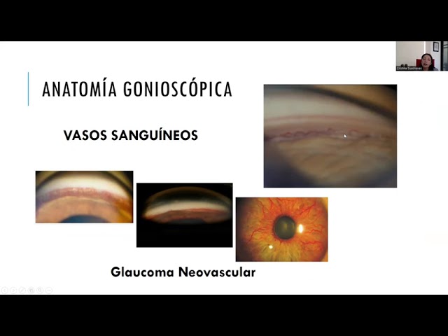 Gonioscopía - Dra Cristina Suasnavas A.