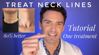 Injectors guide: Treating Neck Lines! Tutorial using dermal fillers