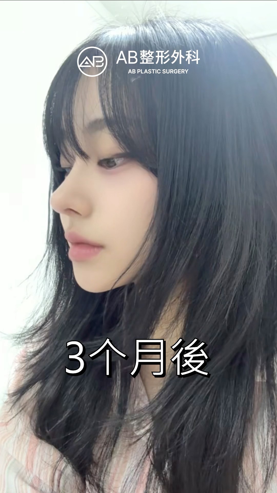 驚人變化！手術後的側顏太驚豔 #shorts