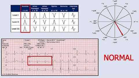 Cardiac Axis Determination