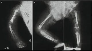 X-rays of Syphilitic sabre tibia; classic radiographic finding seen in congenital syphilis