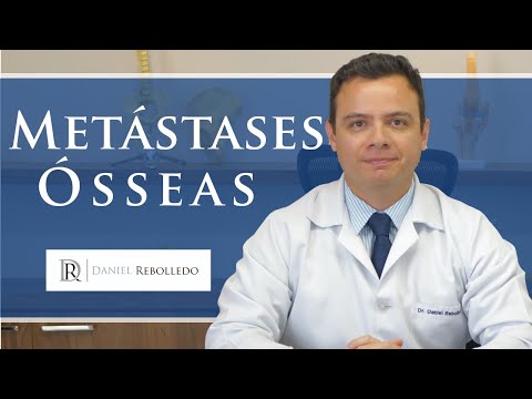 Vídeo: Metástases - Causas, Estágios, Sinais E Sintomas De Metástases, Diagnóstico E Tratamento
