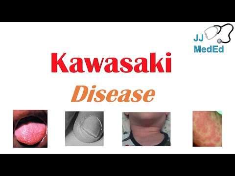 Videó: A Kawasaki -betegség felismerése és kezelése: 15 lépés