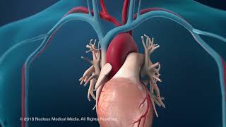 Coronary Artery Angioplasty (Radial Access)  Hindi