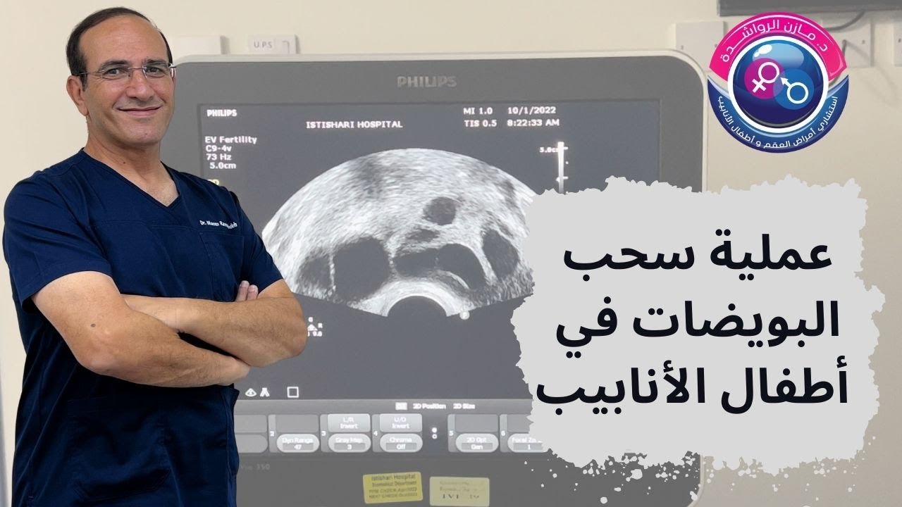 عملية سحب البويضات في أطفال الأنابيب