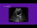 Vscan Air™ Product Tutorial | Auto Bladder Volume
