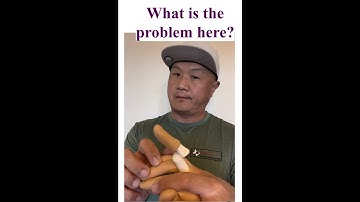 Dorsal Finger Dislocation | Reduction technique | Sports Medicine | Athletic Training |