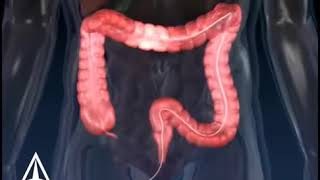 Colonoscopy 3D Medical Animation Mk Medical Center