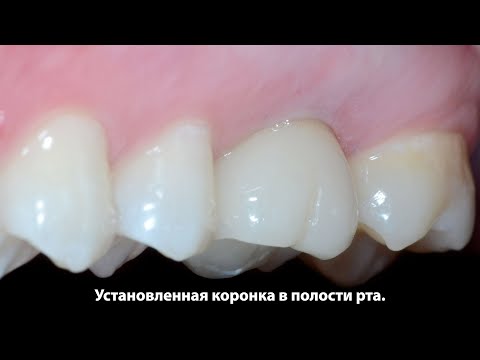 Одномоментная имплантация первого моляра верхней челюсти, протезирование коронкой