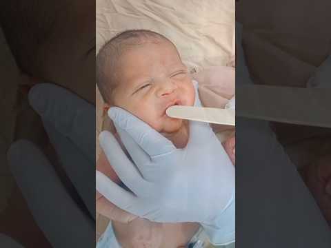 مشكلة فطريات الفم واللسان للأطفال حديثي الولاده وعلاجها