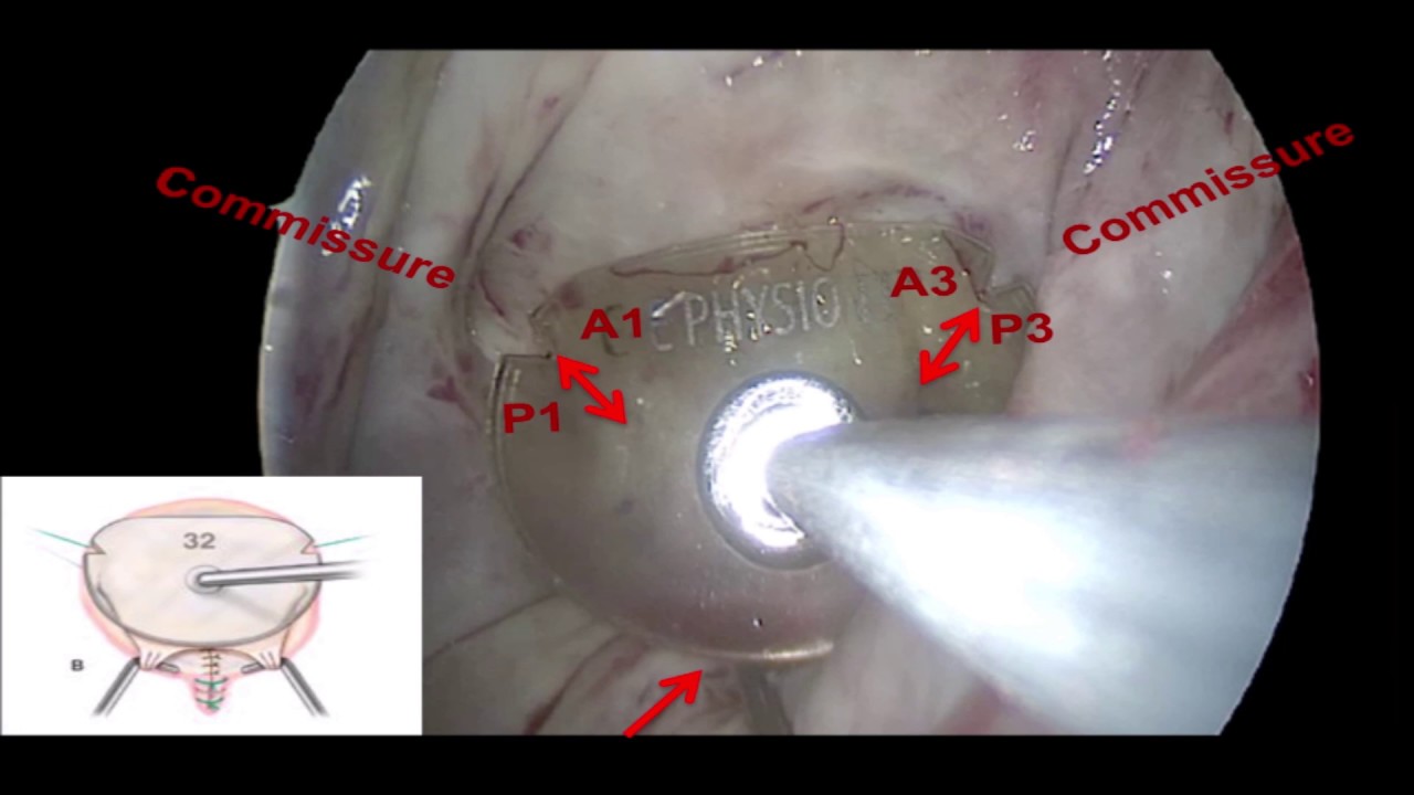 Initial Experience With a New Mitral Ring Designed to Simplify Length  Determination of Neochords