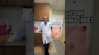 Understanding Basal Cell Carcinoma Understanding Basal Cell Carcinoma