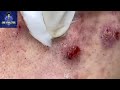 Blackhead and acne treatment watch clinician clean pores of patient suffering from cystic acne