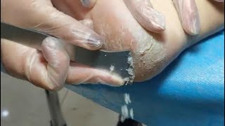 Download lagu So Satisfying. Snowflake And Massive Dead Skin Are Coming. Cracked Heel Treatmen Mp3 Video Mp4