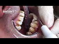 Профессиональная чистка зубов ультразвуком | стоматология Сатори в Самаре