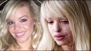 Katie Piper: Acid Attacker Release &#39;Makes This A Really Difficult Time&#39;