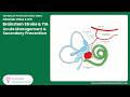 5/6 video- Brainstem Stroke - Acute Management & Secondary Prevention