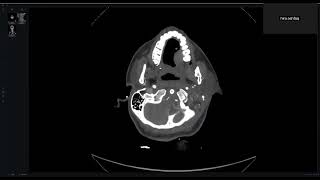 Spine Emergency Cases