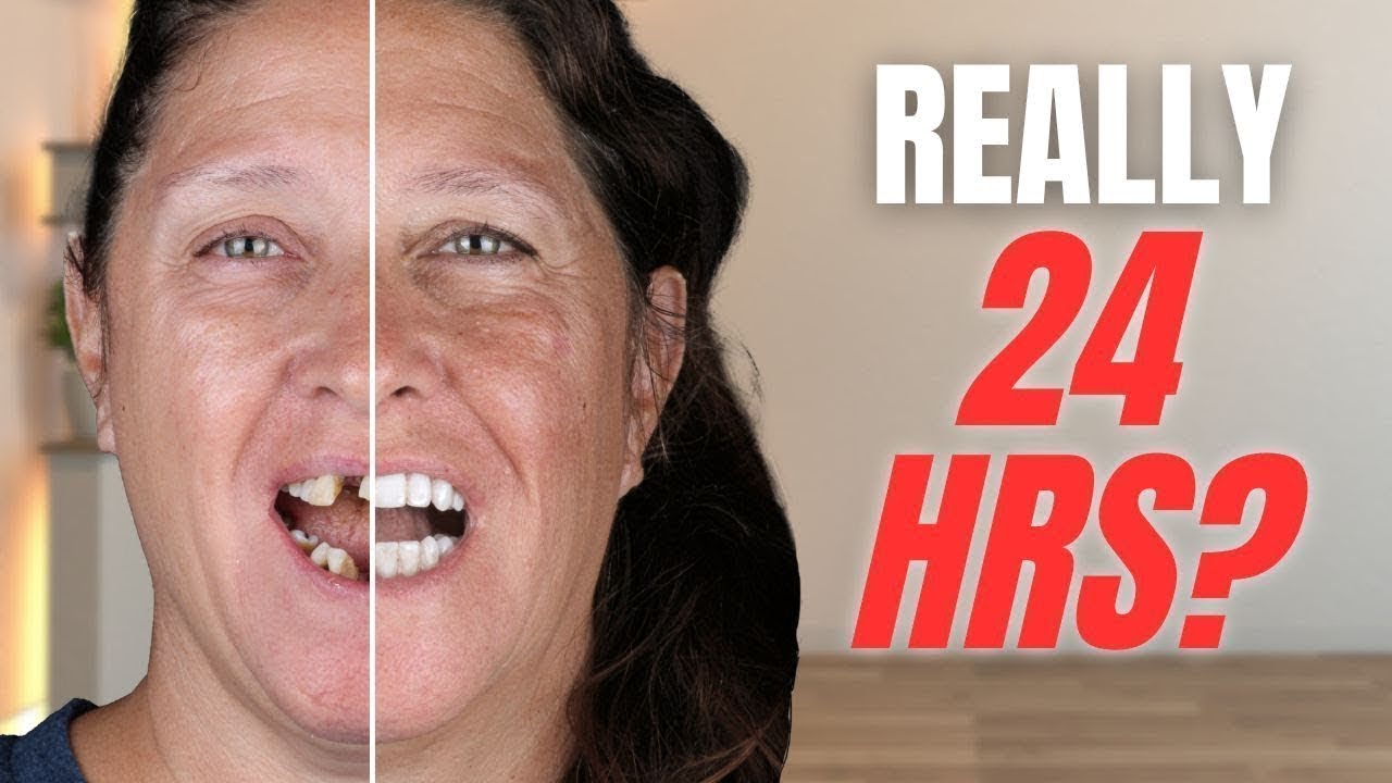 Outline Video Can You Really Get Dental Implants in 24 Hours? My Story