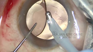 HOW TO REMOVE THE VISCOELASTIC UNDER THE IOL  BY DR SUJATHA MOHAN RAJAN EYE CARE HOSPITAL
