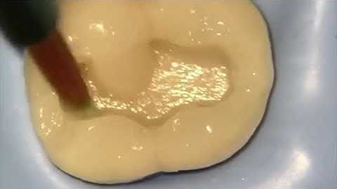 Posterior Direct composite class 1..