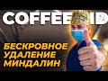 Хронический тонзиллит и бескровная тонзиллэктомия - Кирилл Барциховский | COFFEE.MD