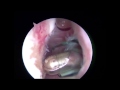 Arthroscopic Anterior Labral Repair with Remplissage