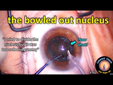 the bowled out nucleus in cataract surgery - now what?