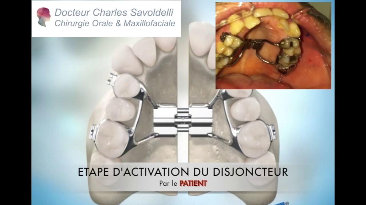 Disjonction palatine/maxillaire chirurgicale YouTube