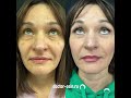 Убрал мимические морщины под глазами  #блефаропластика
