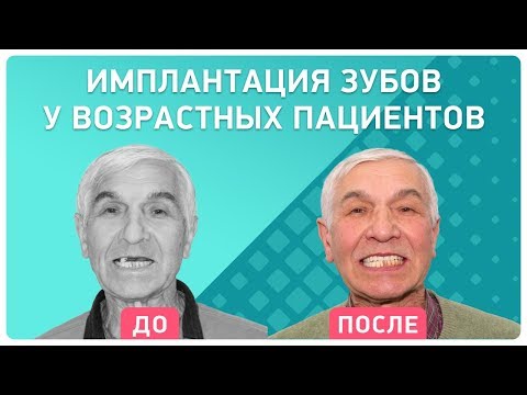 Имплантация зубов после 70 лет. Как приживаются импланты? Отзыв пациента через 1 год после лечения