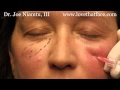 5 minute cheeks by Dr. Joe Niamtu, III