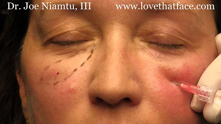 5 minute cheeks by Dr. Joe Niamtu, III