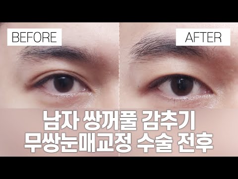 눈 성형 전후 I 남자쌍꺼풀없애기, 무쌍눈매교정 I 강남서연