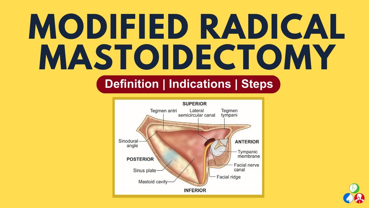Modified Radical Mastoidectomy | Definition, Indications, Surgical Steps