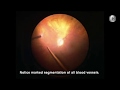 CRAO during vitrectomy: Immediate retinal revascularization following PVD induction