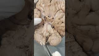 Base of brain #anatomy screenshot 5