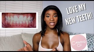 3 Month Update On Invisible Aligners (Before & After) - Candid Co.