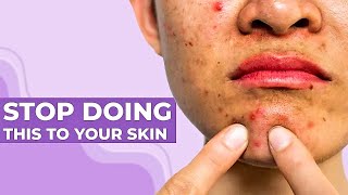 0 Acne Tips No More Fungal Acne & Hormonal Acne