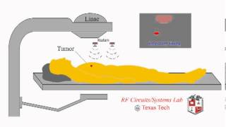 Gated Radiotherapy