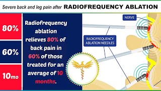 Neurosurgeon explains severe back or leg pain after RADIOFREQUENCY ABLATION