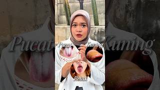 Jangan Abaikan Warna Lidah Ini Bisa Jadi Tanda Bahaya