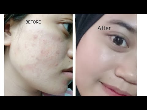 Review Obat Totol Jerawat dari ORIFLAME, Bagaimana sih kualitasnya?. 